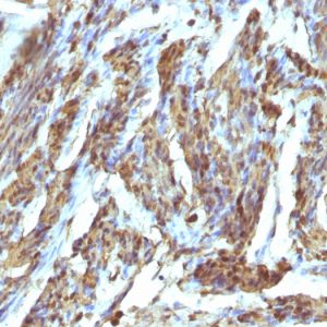 Formalin-fixed, paraffin-embedded human Uterus stained with Calponin Rabbit Polyclonal Antibody