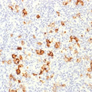 Formalin-fixed, paraffin-embedded human Hodgkin's Lymphoma stained with CD15 Rabbit Polyclonal Antibody.