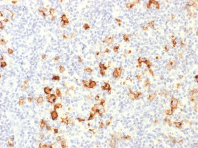 Formalin-fixed, paraffin-embedded human Hodgkin's Lymphoma stained with CD15 Rabbit Polyclonal Antibody.