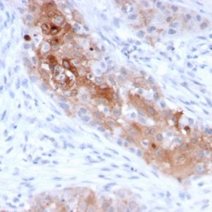 Formalin-fixed, paraffin-embedded human Bladder Carcinoma stained with Desmoglein-1 Mouse Monoclonal Antibody (32-2B).