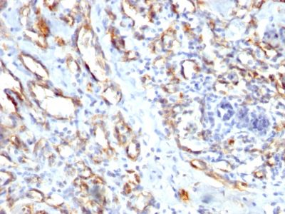 Formalin-fixed, paraffin-embedded human Angiosarcoma stained with CD31 Rabbit Polyclonal Antibody.
