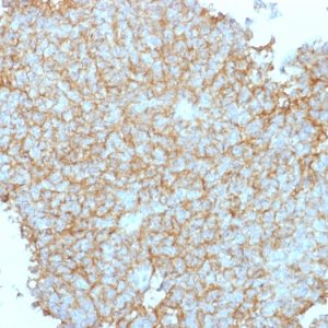 Formalin-fixed, paraffin-embedded human Ewing's Sarcoma (EWS) stained with CD99 Rabbit Polyclonal Antibody.