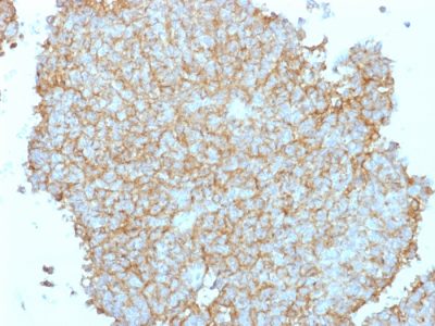 Formalin-fixed, paraffin-embedded human Ewing's Sarcoma (EWS) stained with CD99 Rabbit Polyclonal Antibody.