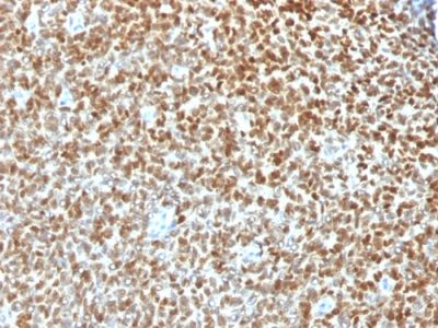 Formalin-fixed, paraffin-embedded human Ewing's Sarcoma stained with NKX2.2 Rabbit Polyclonal Antibody.