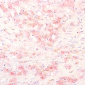 Formalin-fixed, paraffin-embedded human Melanoma stained with TYRP1 Rabbit Polyclonal Antibody using AEC Chromogen (red).