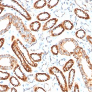 Formalin-fixed, paraffin-embedded human Renal Cell Carcinoma stained with CD137-Monospecific Mouse Monoclonal Antibody (4-1BB/3201).