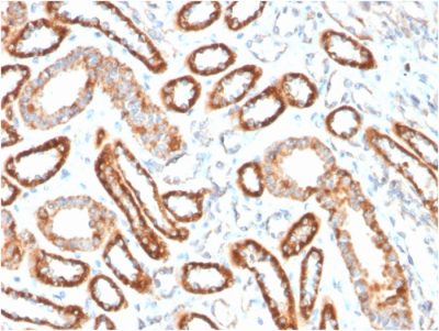 Formalin-fixed, paraffin-embedded human Renal Cell Carcinoma stained with CD137-Monospecific Mouse Monoclonal Antibody (4-1BB/3201).