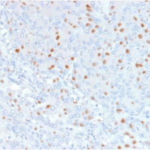 Formalin-fixed, paraffin-embedded human Bladder Carcinoma stained with Annexin A1 Mouse Monoclonal Antibody (6E4/3).