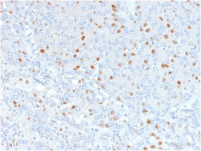 Formalin-fixed, paraffin-embedded human Bladder Carcinoma stained with Annexin A1 Mouse Monoclonal Antibody (6E4/3).