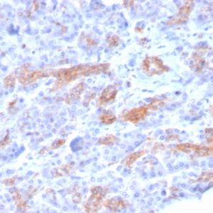 Formalin-fixed, paraffin-embedded human Pancreatic Carcinoma stained with MRP3 Mouse Monoclonal Antibody (ABCC3/2971).