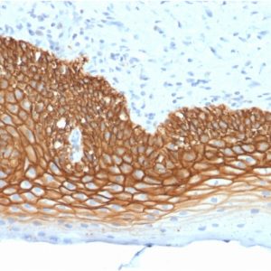 Formalin-fixed, paraffin-embedded human Cervix Carcinoma stained with CD44v3 Mouse Monoclonal Antibody (3G5).