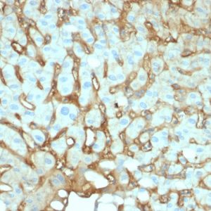 Formalin-fixed, paraffin-embedded human Hepatocellular Carcinoma stained with Albumin Mouse Monoclonal Antibody (ALB/2141).