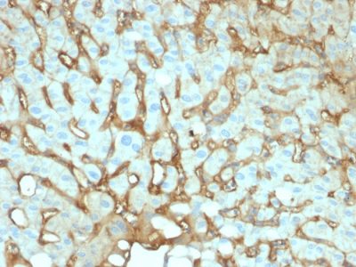 Formalin-fixed, paraffin-embedded human Hepatocellular Carcinoma stained with Albumin Mouse Monoclonal Antibody (ALB/2141).