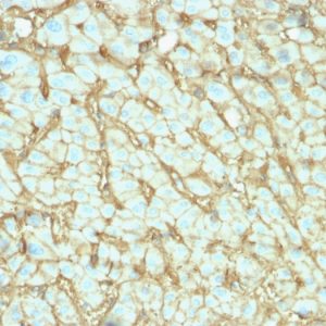 Formalin-fixed, paraffin-embedded human Hepatocellular Carcinoma stained with Albumin-Monospecific Mouse Monoclonal Antibody (ALB/2142).