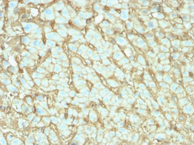 Formalin-fixed, paraffin-embedded human Hepatocellular Carcinoma stained with Albumin-Monospecific Mouse Monoclonal Antibody (ALB/2142).