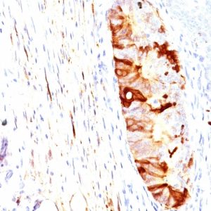 Formalin-fixed, paraffin-embedded human Colon Carcinoma stained with ALDH1A1 Mouse Monoclonal Antibody (ALDH1A1/1382).