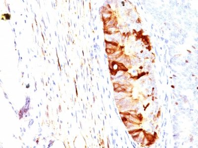 Formalin-fixed, paraffin-embedded human Colon Carcinoma stained with ALDH1A1 Mouse Monoclonal Antibody (ALDH1A1/1382).