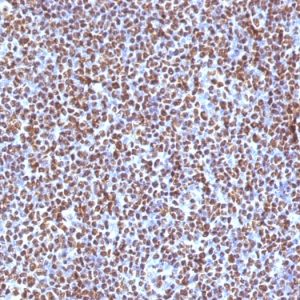 Formalin-fixed, paraffin-embedded human Anaplastic LC Lymphoma stained with ALK-1 Mouse Monoclonal Antibody (ALK/1504).