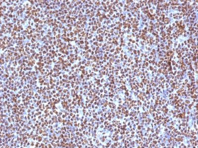Formalin-fixed, paraffin-embedded human Anaplastic LC Lymphoma stained with ALK-1 Mouse Monoclonal Antibody (ALK/1504).