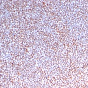 Formalin-fixed, paraffin-embedded human Anaplastic LC Lymphoma stained with ALK-1 Recombinant Rabbit Monoclonal Antibody (ALK/3218R).