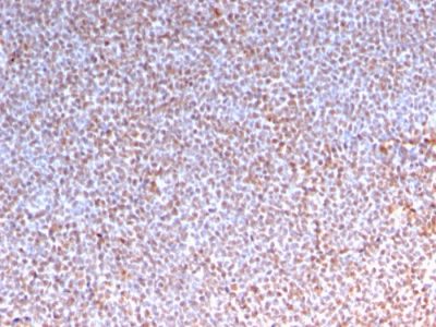 Formalin-fixed, paraffin-embedded human Anaplastic LC Lymphoma stained with ALK-1 Recombinant Rabbit Monoclonal Antibody (ALK/3218R).