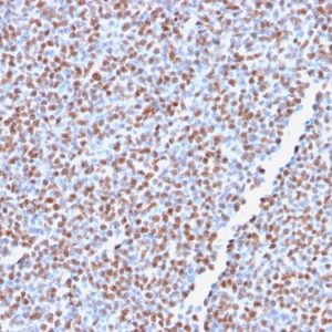 Formalin-fixed, paraffin-embedded human Anaplastic LC Lymphoma stained with ALK-1 Recombinant Rabbit Monoclonal Antibody (ALK1/2766R).