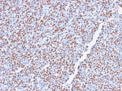 Formalin-fixed, paraffin-embedded human Anaplastic LC Lymphoma stained with ALK-1 Recombinant Rabbit Monoclonal Antibody (ALK1/2766R).