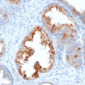 Formalin-fixed, paraffin-embedded human Prostate Carcinoma stained with AMACR / p504S Mouse Monoclonal Antibody (AMACR/1864).