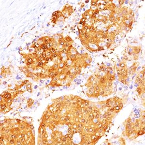 Formalin-fixed, paraffin-embedded human Hepatocellular Carcinoma stained with ARG1 Mouse Monoclonal Antibody (ARG1/1125 + ARG1/1126).
