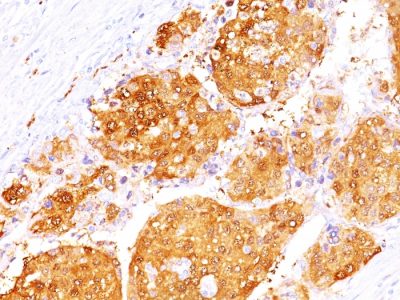 Formalin-fixed, paraffin-embedded human Hepatocellular Carcinoma stained with ARG1 Mouse Monoclonal Antibody (ARG1/1125 + ARG1/1126).