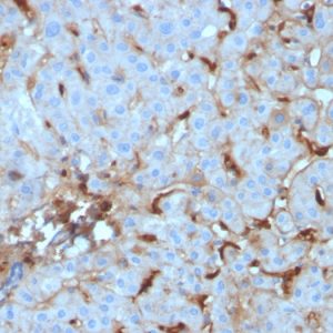 Formalin-fixed, paraffin-embedded human Renal Cell Carcinoma stained with C1QA Mouse Monoclonal Antibody (C1QA/2955).