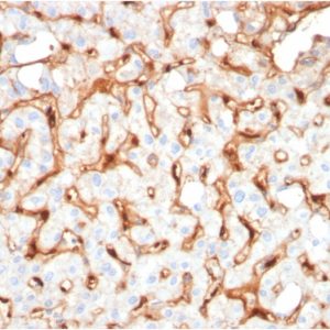 Formalin-fixed, paraffin-embedded human Hepatocellular Carcinoma stained with C1QB Mouse Monoclonal Antibody (C1QB/2965).