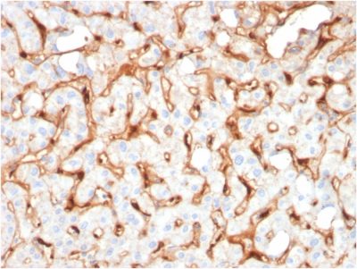 Formalin-fixed, paraffin-embedded human Hepatocellular Carcinoma stained with C1QB Mouse Monoclonal Antibody (C1QB/2965).