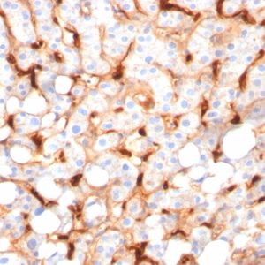 Formalin-fixed, paraffin-embedded human Hepatocellular Carcinoma stained with C1QB Mouse Monoclonal Antibody (C1QB/2966).