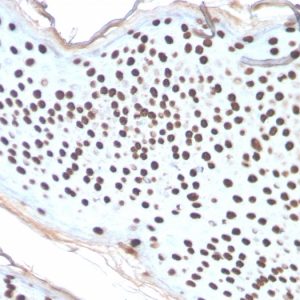 Formalin-fixed, paraffin-embedded human Skin Basal Cell Carcinoma stained with Histone H1 Rabbit Recombinant Monoclonal Antibody (AE-4).