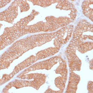 Formalin-fixed, paraffin-embedded human Prostate Carcinoma stained with Calcineurin A Mouse Monoclonal Antibody (CALNA/2353).