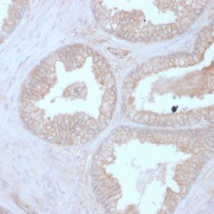 Formalin-fixed, paraffin-embedded human Prostate Carcinoma stained with Calcineurin B Mouse Monoclonal Antibody (CALNB/2342).