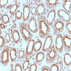 Formalin-fixed, paraffin-embedded human Renal Cell Carcinoma stained with Calnexin Mouse Monoclonal Antibody (CANX/1543).
