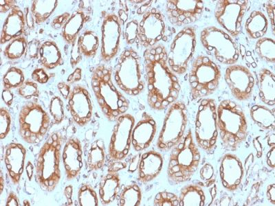 Formalin-fixed, paraffin-embedded human Renal Cell Carcinoma stained with Calnexin Mouse Monoclonal Antibody (CANX/1543).