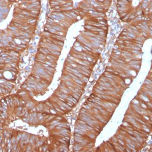Formalin-fixed, paraffin-embedded human Colon Carcinoma stained with Calpastatin Mouse Monoclonal Antibody (CAST/1550).