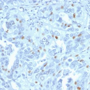 Formalin-fixed, paraffin-embedded human Endometrial Carcinoma stained with Cyclin A2 Mouse Monoclonal Antibody (CCNA2/2333).