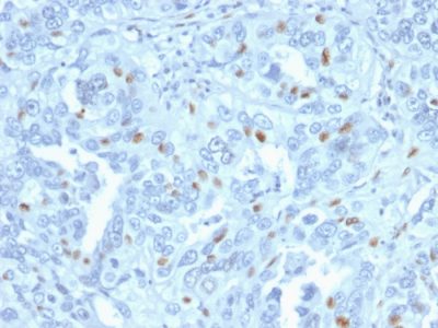 Formalin-fixed, paraffin-embedded human Endometrial Carcinoma stained with Cyclin A2 Mouse Monoclonal Antibody (CCNA2/2333).