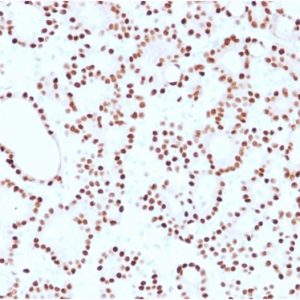 Formalin-fixed, paraffin-embedded human thyroid carcinoma stained with Cyclin D1 Mouse Monoclonal Antibody (CCND1/2593).