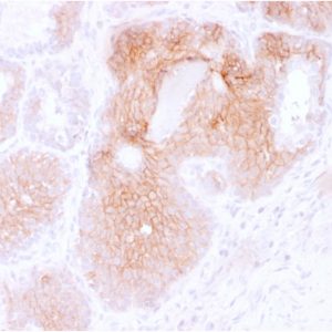 Formalin-fixed, paraffin-embedded human Prostate Carcinoma stained with CD44v6 Mouse Monoclonal Antibody (CD44V6/2496).