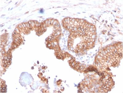 Formalin-fixed, paraffin-embedded human Prostate Carcinoma stained with CD47 Mouse Monoclonal Antibody (IAP/2937).