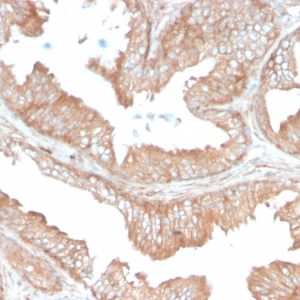 Formalin-fixed, paraffin-embedded human Prostate Carcinoma stained with CD47 Mouse Monoclonal Antibody (IAP/3019).