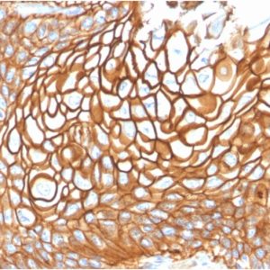 Formalin-fixed, paraffin-embedded human Basal Cell Carcinoma stained with CD9 Mouse Monoclonal Antibody (CD9/1619).