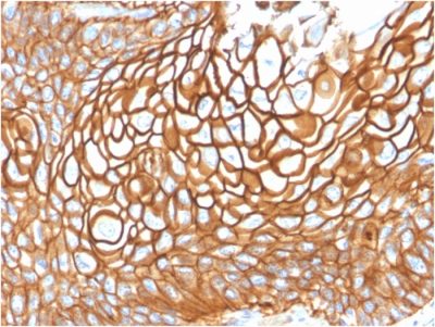 Formalin-fixed, paraffin-embedded human Basal Cell Carcinoma stained with CD9 Mouse Monoclonal Antibody (CD9/1619).