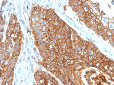 Formalin-fixed, paraffin-embedded human Cervical Carcinoma stained with CD9 Mouse Monoclonal Antibody (CD9/2343).