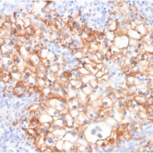 Formalin-fixed, paraffin-embedded human Renal Cell Carcinoma stained with CDH16-Monospecific Mouse Monoclonal Antibody (CDH16/2125).